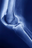 Лечение артроза коленных суставов по дикулю thumbnail