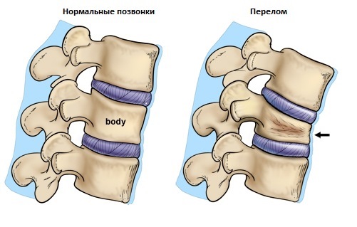 Дикуль упражнения для спины при переломе thumbnail