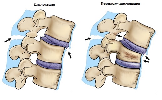 Центр дикуля перелом позвоночника