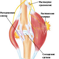Лечение болезни мышц рук и ног thumbnail