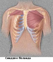 Кифоз грудного отдела позвоночника (искривление)