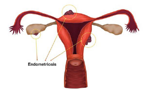 Диагностика эндометриоза тела матки