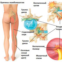 Боль в ягодице отдающая в ногу: причины и лечение