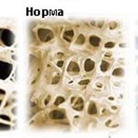 Что такое остеопороз позвоночника и как его лечить