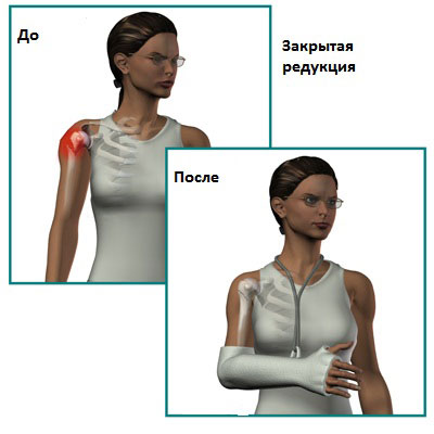 Контрольная работа по теме Переломы плечевой кости