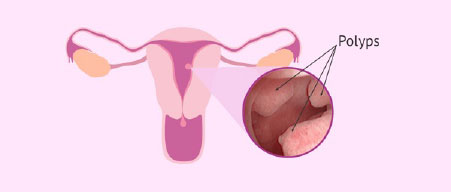 Удаление полипов женских половых органов