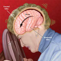 Чем лечить головную боль после сотрясения мозга