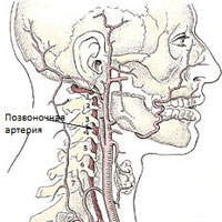 Синдром позвоночной артерии : симптомы, лечение в Алматы, Астане - Expert Neuro