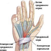 тоннельный нерв на правой руке