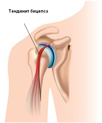 Разрыв сухожилия двуглавой мышцы плеча