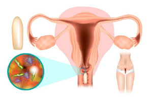 Грибковые заболевания и инфекции влагалища у женщин — блог медицинского центра ОН Клиник