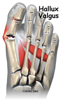 Лечение перелома пальца ноги